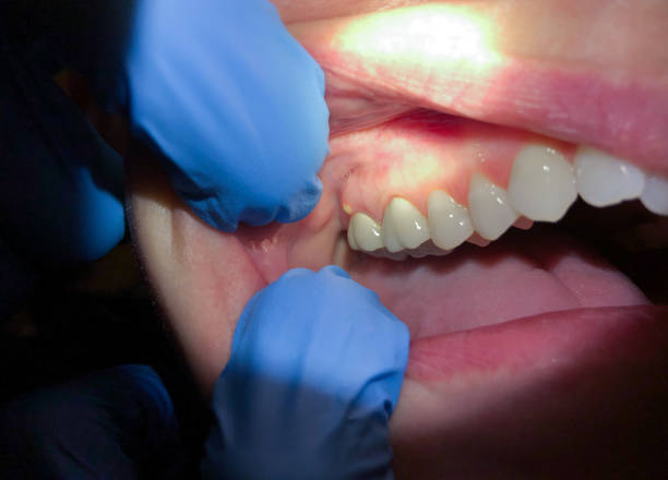Best Emergency Tooth Extraction in Winter Beach, FL